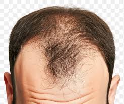 hairfall